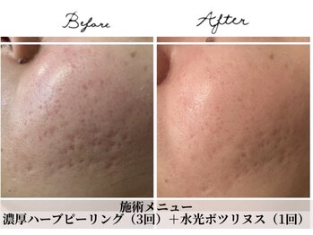 アリュール 倉敷(ALLURE)/【水光ボニックスフェイシャル】