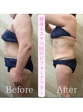 介正鍼灸整骨院 整体院 エフコープ大野城店/痩身エステ＊ビフォーアフター
