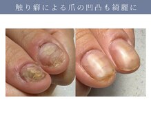 イデアル(ide’al)/触り癖によるトラブルネイル