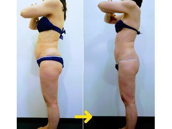 ハート 大分(heart)/切除VSインディバ