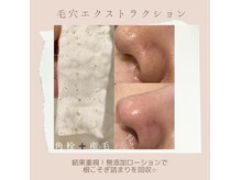 tete式毛穴エクストラクション♪1度の施術でイチゴ鼻を卒業☆