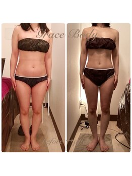 グレイスボディ BiViつくば店(Grace Body)/◆痩身　症例写真