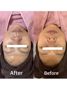 ラ フルール(La Fleur)/エアバリフェイシャル