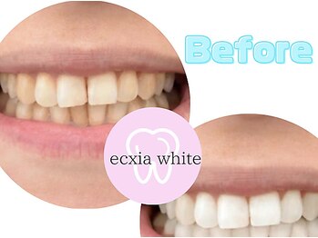 エクシアホワイトニング 西尾店/ビフォーアフター