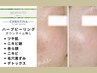 【肌質改善】≪ハーブピーリング≫ダウンタイム無≪脂性肌・黒ずみ・ニキビ≫