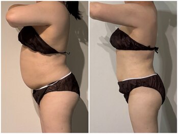 OBS/脂肪冷却プログラム×体重減少