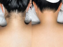 大人気☆シュガーリング×光脱毛でツルスベ肌♪チクチク感ゼロ
