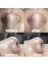 ビューティーネイル(Beauty Nail)/毛穴エクストラクション