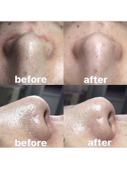 ビューティーネイル(Beauty Nail)/毛穴エクストラクション