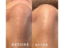 カウニス るる(kaunis)/【ララピール】Before After