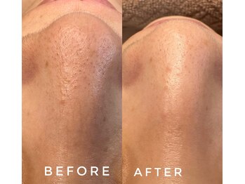 カウニス るる(kaunis)/【ララピール】Before After