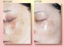 ジュリア オージェ 四条河原町店/ ビフォーアフター（シミケアP）