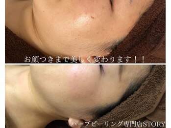 ストーリー(STORY)/ハーブピーリング専門店STORY