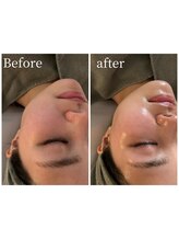 モイ(moi.)/◆Wピーリング◆