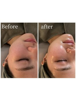 モイ(moi.)/◆Wピーリング◆