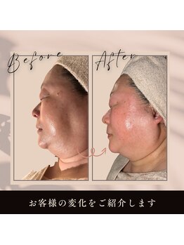 ボディケアサロン アイリフ(airef)/ピーリング&エクソソーム導入