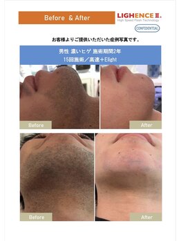 マル(MARU)/脱毛　～Before、After～