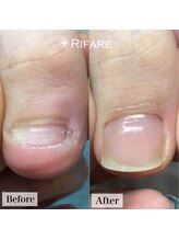 リファーレ(RIFARE)/【深爪矯正】爪が生えた！