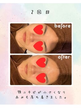 リリアン(lirien)/毛穴/毛穴ケア/毛穴洗浄/駒込