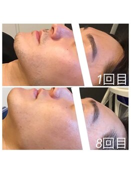 メンズ脱毛 ウィッシュ(Wish)/ヒゲ脱毛　８回目　