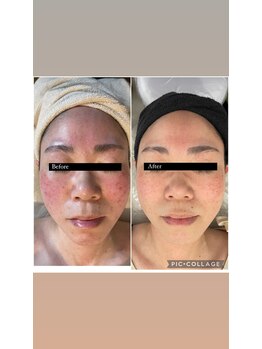 アズリー ルナ(AzRee Luna)/ハーブトリートメント