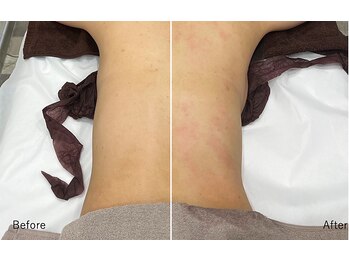 おふ 三宮店(off)/ラジオ波吸引×痩身リンパ