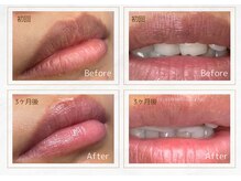 セレーノ 横浜(seReno)/ルメラ　リップビフォアフ