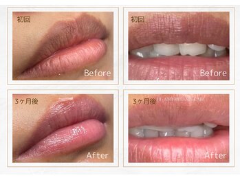 セレーノ 横浜(seReno)/ルメラ　リップビフォアフ