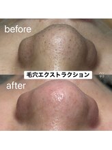 ハリサク/初回施術