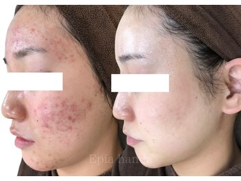 エピア 半田店(Epia)/繰り返すニキビ・敏感肌ケア