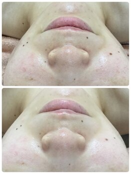 メイユール(MEILLEUR)/光フェイシャル1回