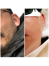 みんなのLED脱毛/男性・ひげ脱毛施術