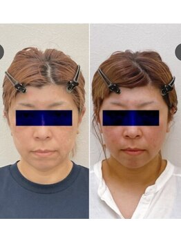 小顔22 ボルティ 本店(Bolty)/スーパー小顔輪郭矯正の流れ