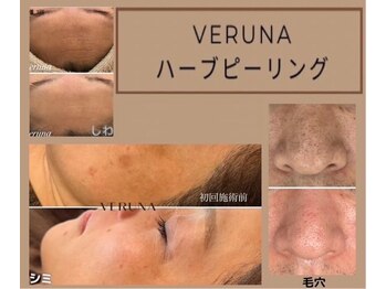 ココ 2号店(CoCo)/VERUNAハーブピーリング