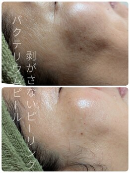 ル クラージュ(Le courage)/バクテリウムピール(50代女性)