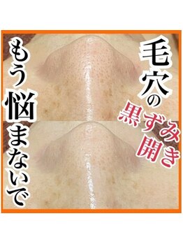 エステ ココ 土気店(Esthe CoCo)/#毛穴#毛穴洗浄