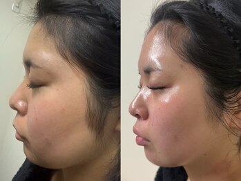 サロン エマ(salon emma)の写真/最強小顔施術*脂肪分解マイクロ波リフト×チタニウムリフト/ボリュームダウンしながら引き締め