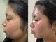 サロン エマ(salon emma)の写真/最強小顔施術*脂肪分解マイクロ波リフト×チタニウムリフト/ボリュームダウンしながら引き締め