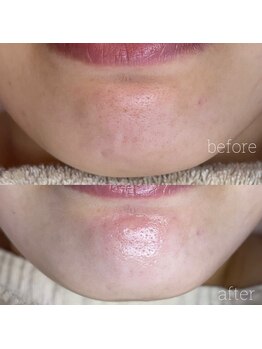 アデュラリアン(Adularian)/毛穴エクストラクション