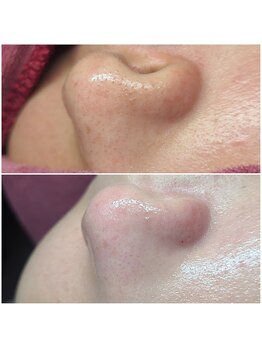 ウォーマル(warmaL)/毛穴エクストラクション