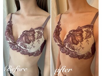 美バストアルファ(美bust α)/【バストアップ】症例