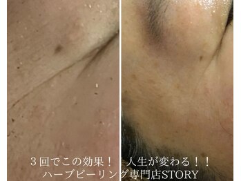 ストーリー(STORY)/ハーブピーリング専門店STORY