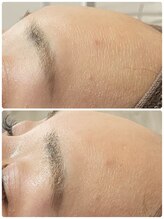 ニコリ(Nicori)/ハーブピーリング