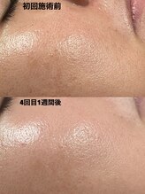 アットウィル 志木店(at will)/☆マイクロニードルピーリング☆