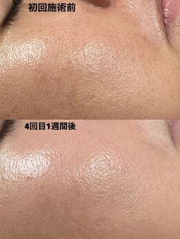 アットウィル 志木店(at will)/☆マイクロニードルピーリング☆