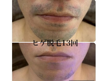 マーレン(Malen)/男性ヒゲ脱毛13回