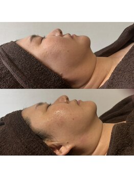 ホウレイ線・たるみ改善！予防ケア