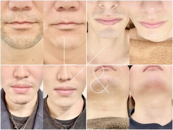 ランド 中目黒(L&)/最新美肌脱毛☆高出力