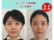 ピュアハリ/沖縄美容鍼/たるみ/効果