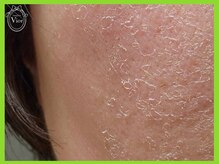 ハーブピーリング 名古屋/ハーブピーリング